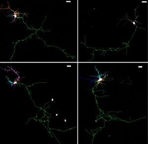 El factor neurotrófico BDNF restaura el crecimiento ramificación neuronal en las células con NHE6 defectos genéticos. La fila superior muestra una neurona sin defecto (izquierda) y una neurona menos ramificada con el defecto NHE6 (derecha). Las neuronas inferiores (ningún defecto a la izquierda, con un defecto de la derecha) recibieron BDNF. (Crédito: Morrow lab / Universidad Brown)