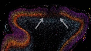 El análisis post-mortem de tejido cerebral reveló áreas de manchas como de neuronas desorganizados. Las flechas muestran en una mancha la disminución o ausencia de expresión de marcadores genéticos a través de múltiples capas de la corteza prefrontal dorsolateral. Foto: Rich Stoner, Ph.D., University of California, San Diego